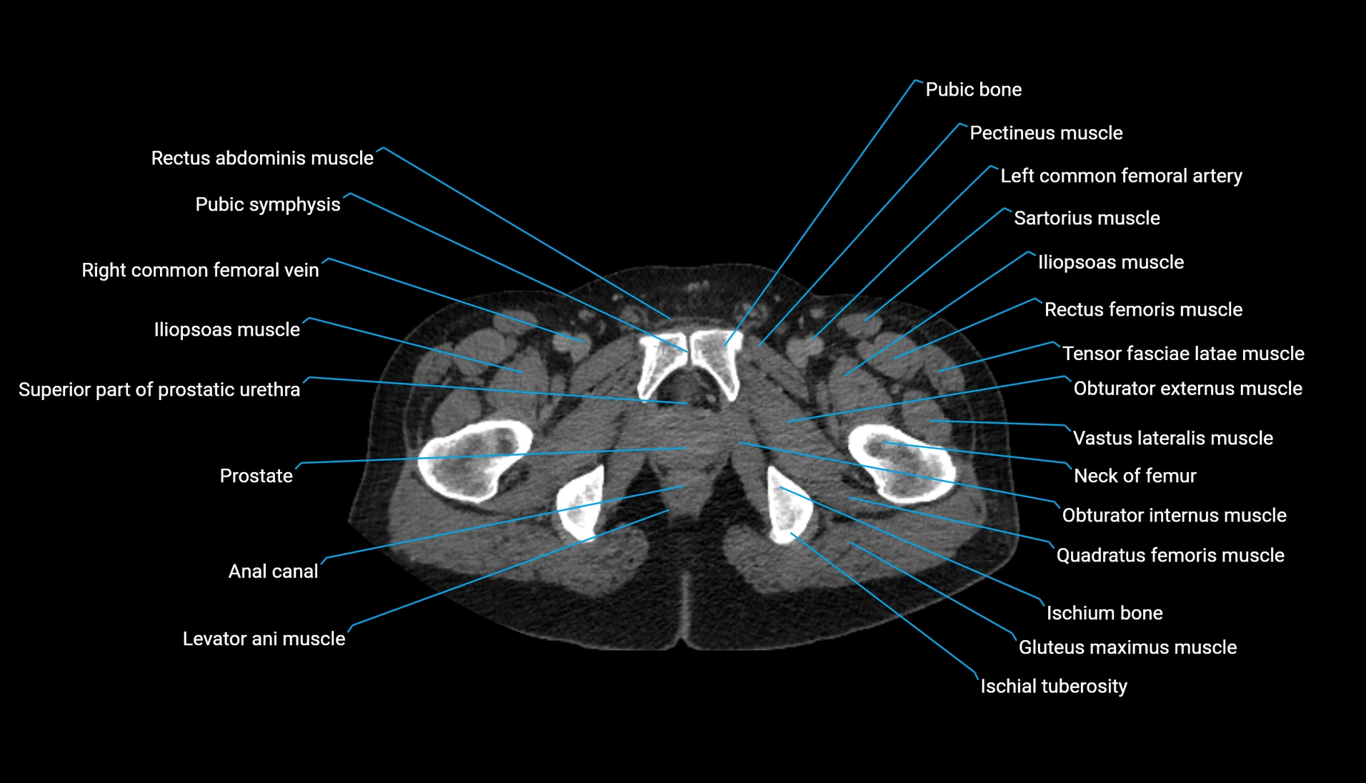 CT urogram axial cross sectional anatomy  labelled radiology image-00253.webp